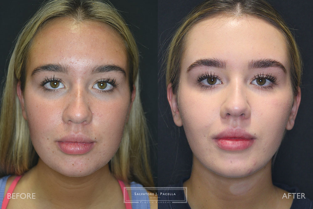 San Diego | La Jolla | Carmel Valley | Del Mar | Encinitas | Plastic Surgery | Cosmetic Surgery | Facelift | Browlift | Fat Transfer | Facial Rejuvenation | Top | Plastic Surgeon | Deep plane facelift