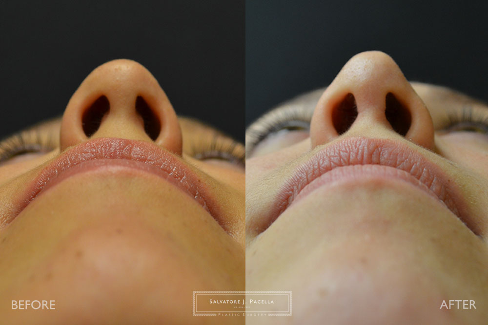 San Diego | La Jolla | Carmel Valley | Del Mar | Encinitas | Plastic Surgery | Cosmetic Surgery | Nose Job | Chin Implant | Top Plastic Surgeon | Scripps Plastic Surgeon | Rhinoplasty