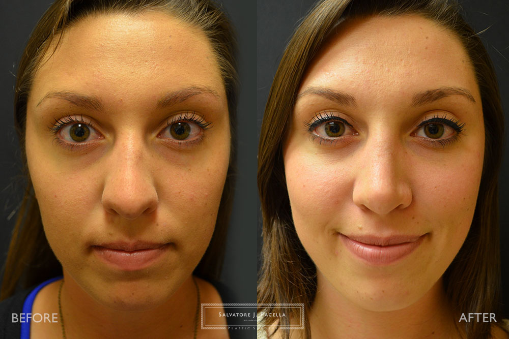 San Diego | La Jolla | Carmel Valley | Del Mar | Encinitas | Plastic Surgery | Cosmetic Surgery | Nose Job | Chin Implant | Top Plastic Surgeon | Scripps Plastic Surgeon | Rhinoplasty