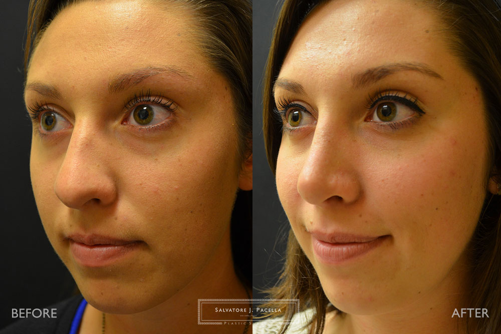 San Diego | La Jolla | Carmel Valley | Del Mar | Encinitas | Plastic Surgery | Cosmetic Surgery | Nose Job | Chin Implant | Top Plastic Surgeon | Scripps Plastic Surgeon | Rhinoplasty