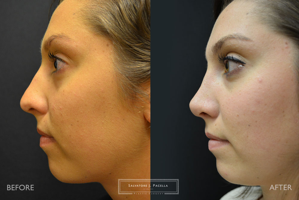 San Diego | La Jolla | Carmel Valley | Del Mar | Encinitas | Plastic Surgery | Cosmetic Surgery | Nose Job | Chin Implant | Top Plastic Surgeon | Scripps Plastic Surgeon | Rhinoplasty