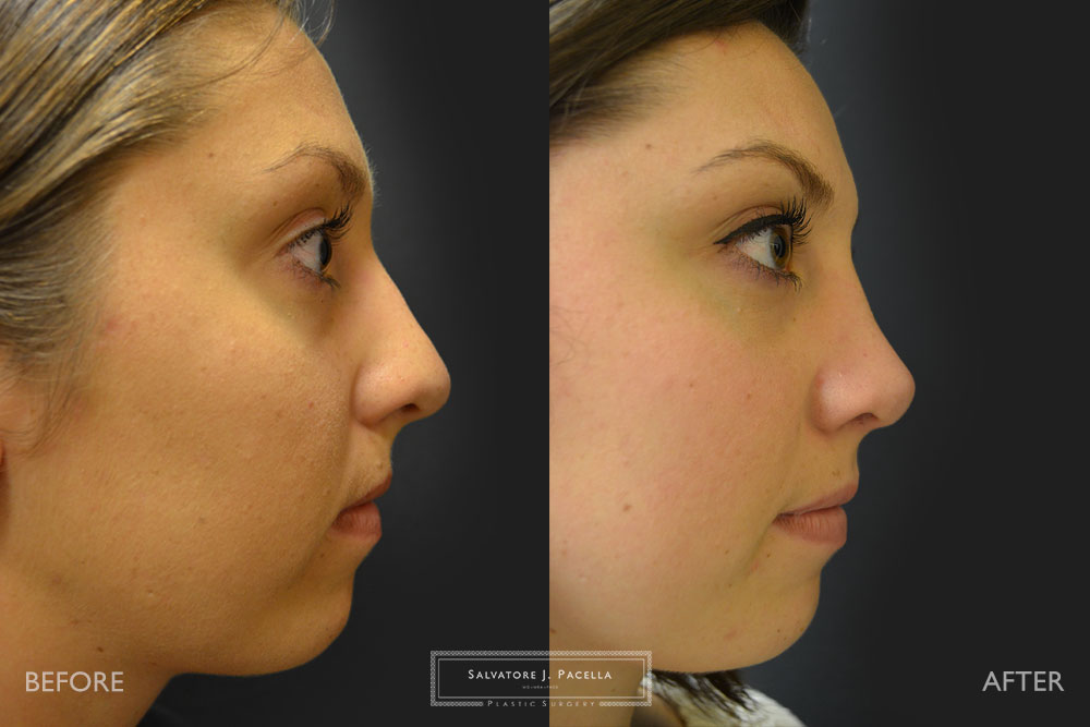 San Diego | La Jolla | Carmel Valley | Del Mar | Encinitas | Plastic Surgery | Cosmetic Surgery | Nose Job | Chin Implant | Top Plastic Surgeon | Scripps Plastic Surgeon | Rhinoplasty