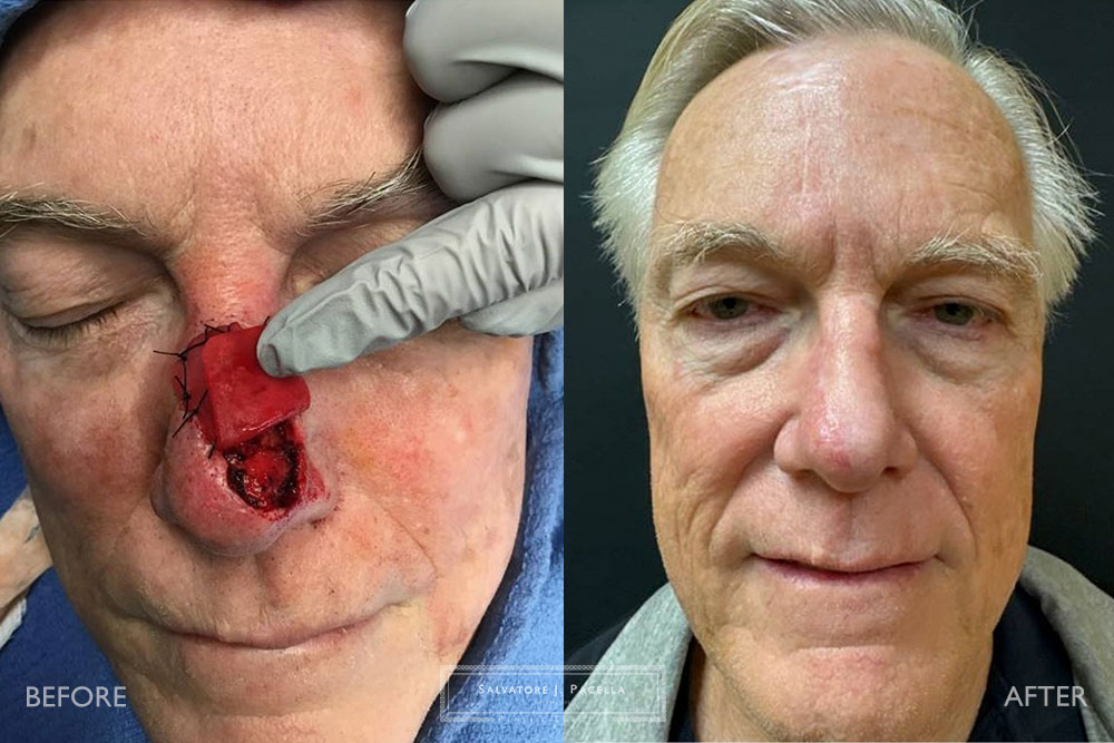 San Diego | La Jolla | Carmel Valley | Del Mar | Dr Pacella Best Plastic Surgeon | Canthopexy | Mohs Surgery | Plastic Surgery