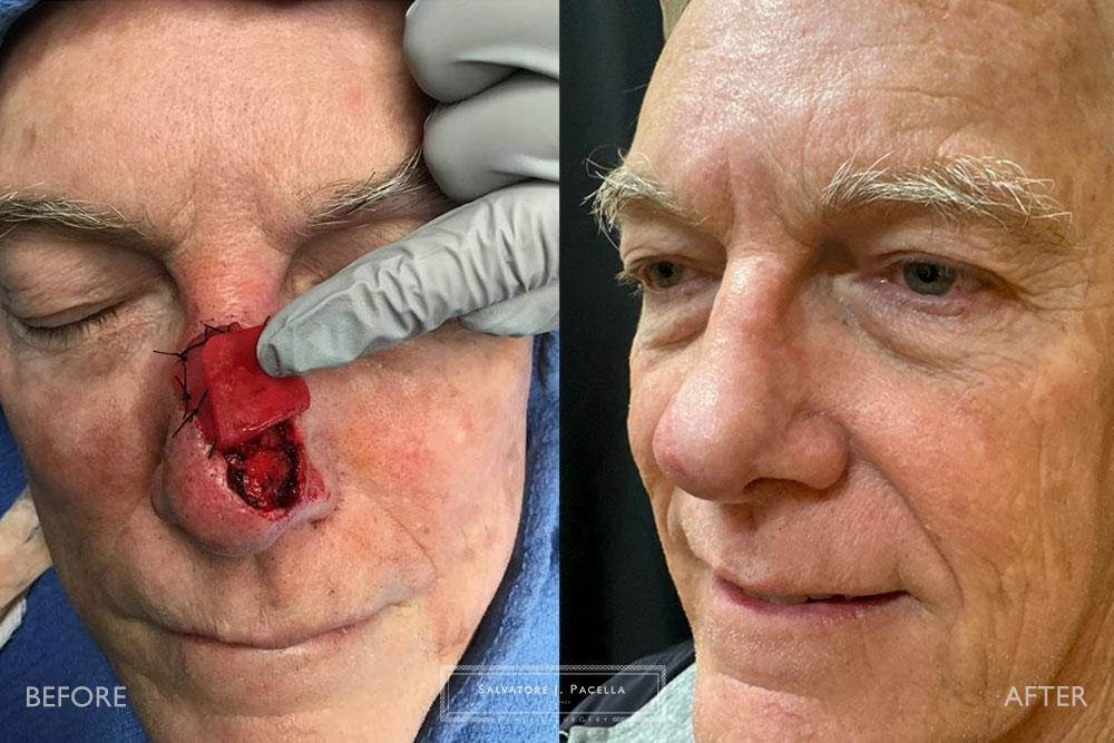 San Diego | La Jolla | Carmel Valley | Del Mar | Dr Pacella Best Plastic Surgeon | Canthopexy | Mohs Surgery | Plastic Surgery