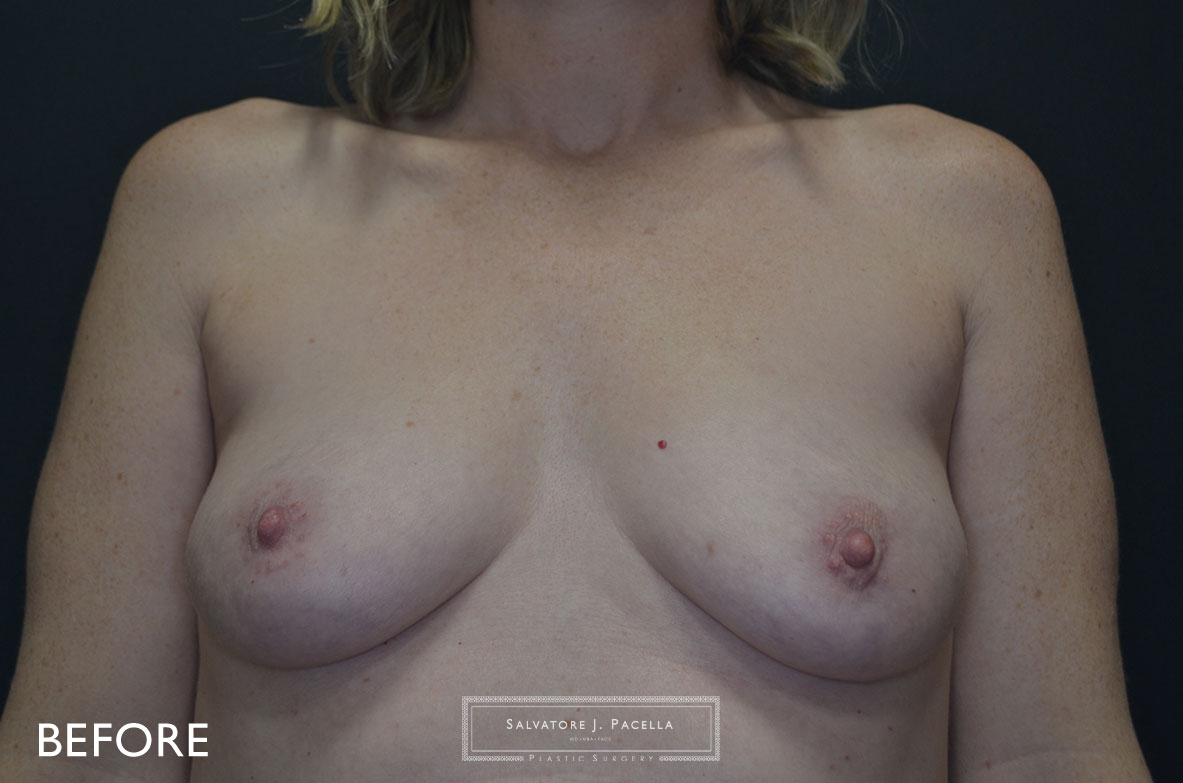 San Diego | La Jolla | Carmel Valley | Del Mar | Encinitas | Plastic Surgery | Cosmetic Surgery | Breast Augmentation San Diego | Boob Job | Breast Implants San Diego | MemoryGel | Silicone Breast Implant | Breast Assymmetry | Moderate Profile | | Silicone vs Saline | Gummy Bear Implant | Mentor Breast Implant