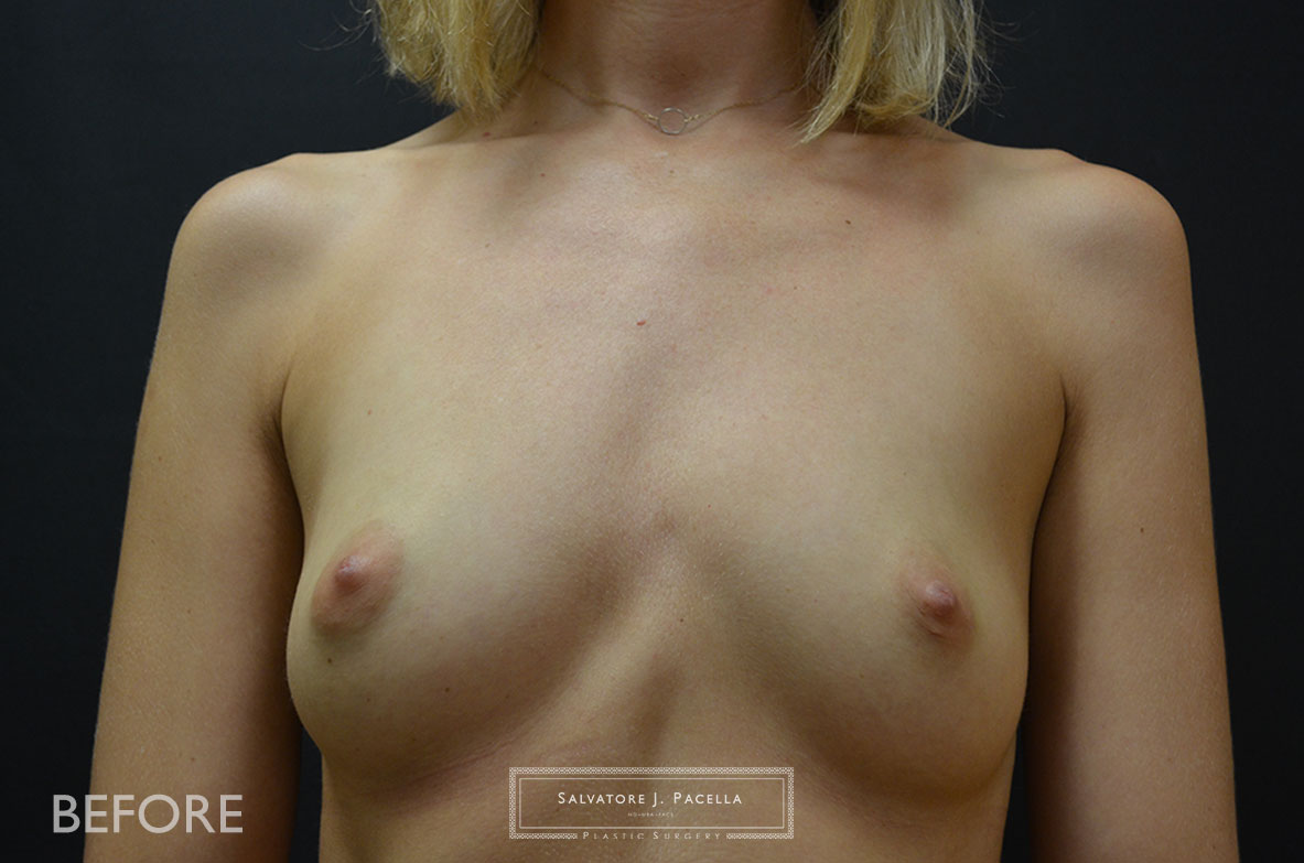 Scripps Plastic Surgeon | Breast Reconstruction | Mastectomy | Breast Implants | Del Mar | San Diego | La Jolla | Plastic Surgery | Reconstructive Surgery | Breast Surgery | Tissue expanders | Artoura | Mentor breast implants | Sientra breast implants