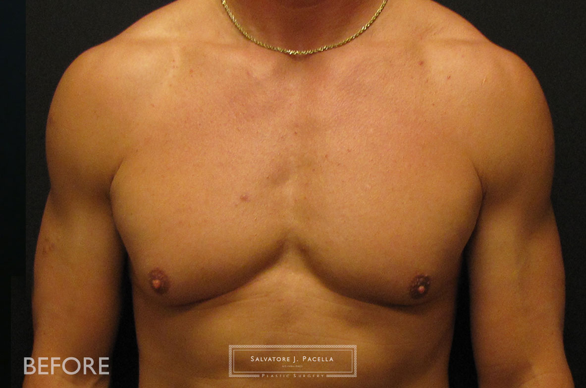 San Diego | La Jolla | Carmel Valley | Del Mar | Plastic Surgery | Gynecomastia | Male Breast Reduction | Top Plastic Surgeon | Scripps Plastic Surgeon