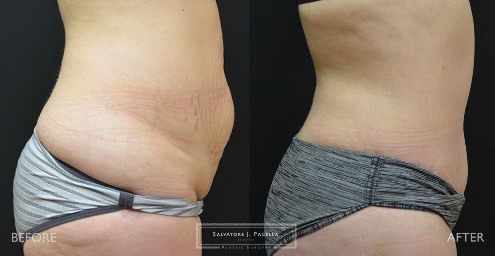 San Diego | La Jolla | Carmel Valley | Del Mar | Encinitas | Plastic Surgery | Body Contouring | Tummy Tuck | Mommy Makeover | Boob Job | Breast Augmentation | Top Plastic Surgeon | Abdominoplasty