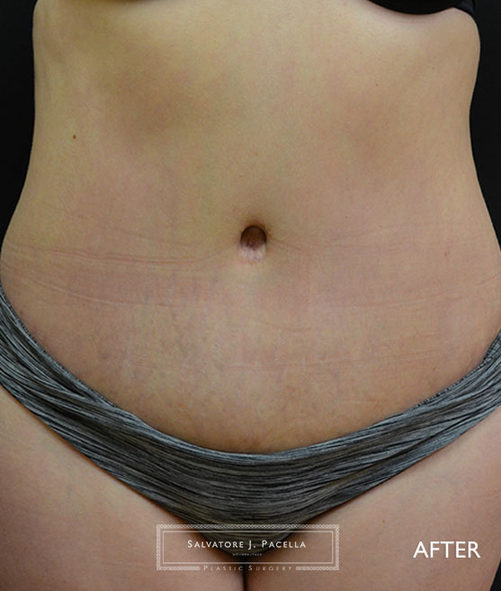 San Diego | La Jolla | Carmel Valley | Del Mar | Encinitas | Plastic Surgery | Body Contouring | Tummy Tuck | Mommy Makeover | Boob Job | Breast Augmentation | Top Plastic Surgeon | Abdominoplasty