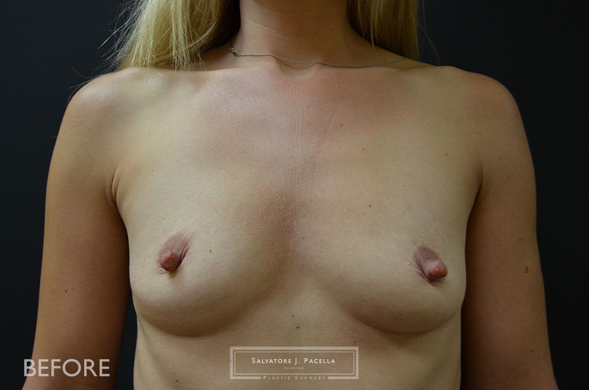 San Diego | La Jolla | Carmel Valley |Del Mar | Encinitas | Plastic Surgery | Cosmetic Surgery | Breast Augmentation San Diego | Boob Job | Breast Implants San Diego | MemoryGel | Silicone Breast | Natural Breast shape | Moderate Profile | Silicone vs Saline | Gummy Bear Implant | Mentor Breast Implants | Silicone Breast implants