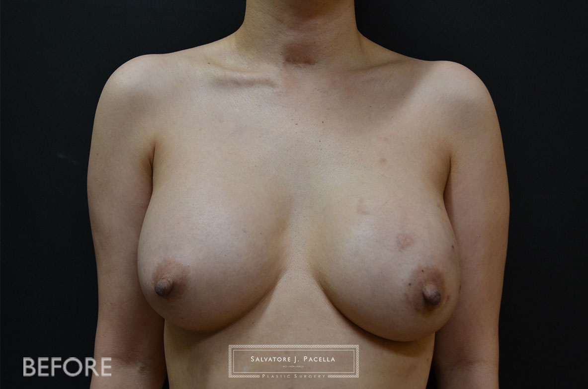 Scripps Plastic Surgeon | Breast Reconstruction | Mastectomy | Breast Implants | Del Mar | San Diego | La Jolla | Plastic Surgery | Reconstructive Surgery | Breast Surgery | Tissue expanders | Artoura | Mentor breast implants | Sientra breast implants