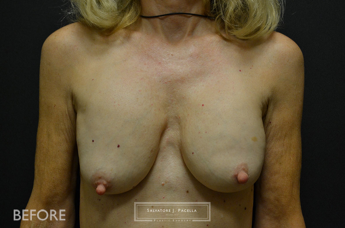 Scripps Plastic Surgeon | Plastic Surgery | Cosmetic Surgery | Breast Revision | Mastopexy | Sientra breast implants | Del Mar | San Diego | La Jolla | Breast Implants