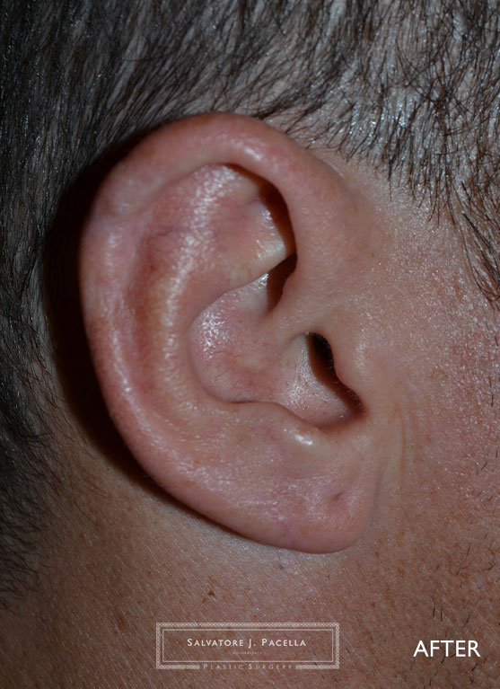 Cosmetic Ear | San Diego Otoplasty | La Jolla Otoplasty | Carmel Valley Otoplasty | San Diego Ear Pinning | La Jolla Ear Pinning | Carmel Valley Ear Pinning | Del Mar Ear Pinning | San Diego Plastic Surgery | La Jolla Plastic Surgery | Carmel Valley Plastic Surgery | Del Mar Plastic Surgery | Scripps Plastic Surgeon