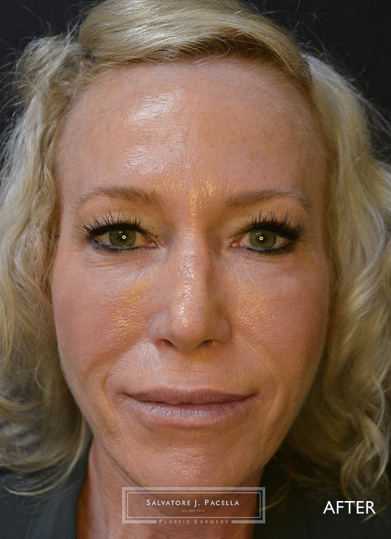 San Diego Rhinoplasty | La Jolla Rhinoplasty | Carmel Valley Rhinoplasty | Del Mar Rhinoplasty | San Diego Nose Job | La Jolla Nose Job | Carmel Valley Nose Job | Del Mar Nose Job | San Diego Chin Implant | La Jolla Chin Implant | Carmel Valley Chin Implant | Del Mar Chin Implant | San Diego Plastic Surgery | La Jolla Plastic Surgery | Carmel Valley Plastic Surgery | Del Mar Plastic Surgery | Scripps Plastic Surgeon