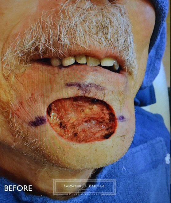 Mohs surgery | Skin Cancer Reconstruction | Best Plastic surgeon | Dr. Pacella