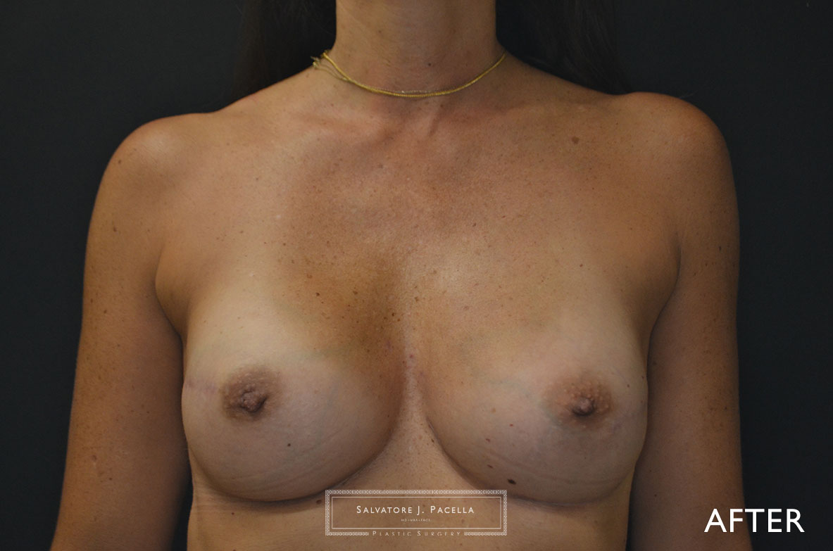 Scripps Plastic Surgeon | Breast Reconstruction | Mastectomy | Breast Implants | Del Mar | an Diego | La Jolla | Plastic Surgery | Reconstructive Surgery | Breast Surgery | Tissue expanders | Artoura | Mentor breast implants