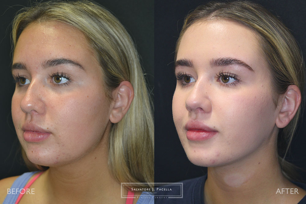 San Diego | La Jolla | Carmel Valley | Del Mar | Encinitas | Plastic Surgery | Cosmetic Surgery | Facelift | Browlift | Fat Transfer | Facial Rejuvenation | Top | Plastic Surgeon | Deep plane facelift