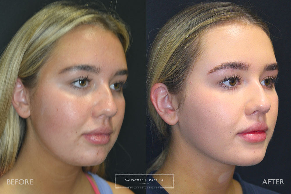 San Diego | La Jolla | Carmel Valley | Del Mar | Encinitas | Plastic Surgery | Cosmetic Surgery | Facelift | Browlift | Fat Transfer | Facial Rejuvenation | Top | Plastic Surgeon | Deep plane facelift