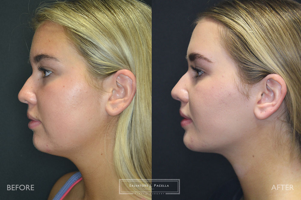 San Diego | La Jolla | Carmel Valley | Del Mar | Encinitas | Plastic Surgery | Cosmetic Surgery | Facelift | Browlift | Fat Transfer | Facial Rejuvenation | Top | Plastic Surgeon | Deep plane facelift