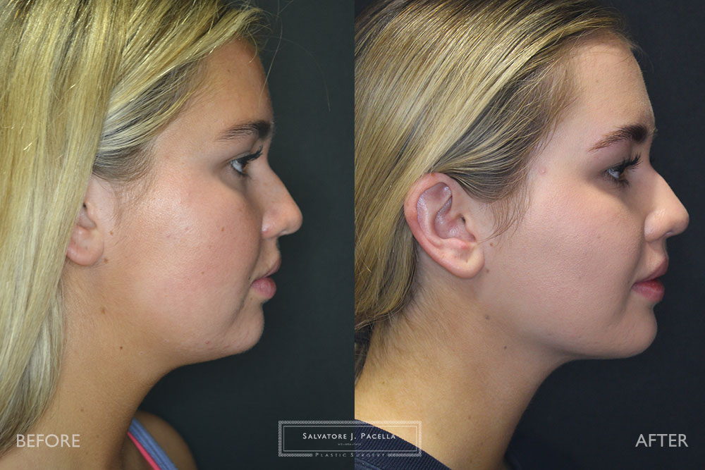 San Diego | La Jolla | Carmel Valley | Del Mar | Encinitas | Plastic Surgery | Cosmetic Surgery | Facelift | Browlift | Fat Transfer | Facial Rejuvenation | Top | Plastic Surgeon | Deep plane facelift