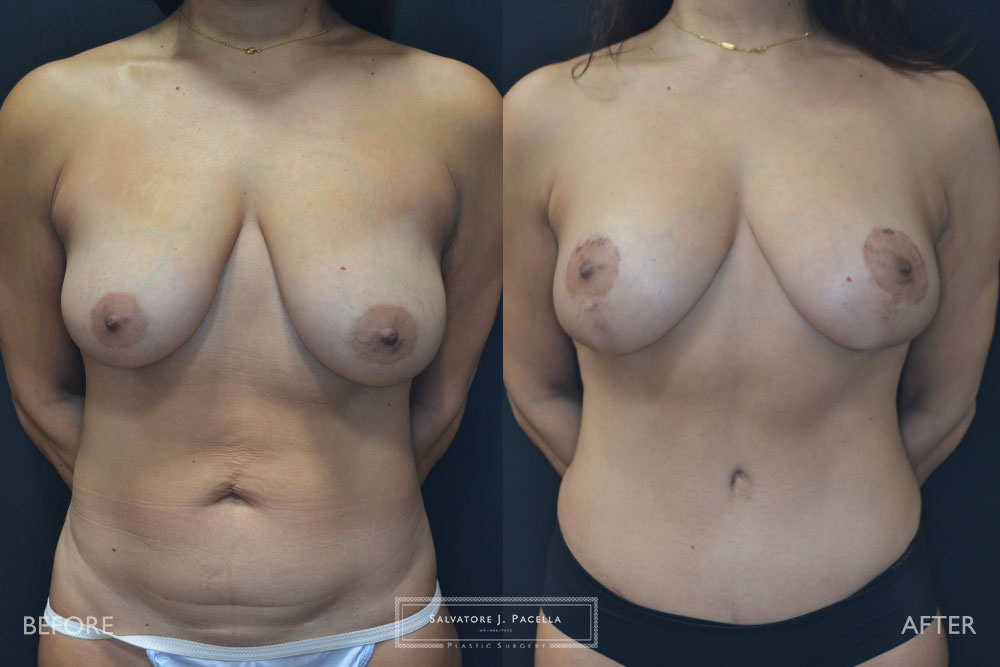 San Diego | La Jolla | Carmel Valley | Del Mar | Encinitas | Plastic Surgery | Body Contouring | Tummy Tuck | Mommy Makeover | Boob Job | Breast Augmentation | Top Plastic Surgeon