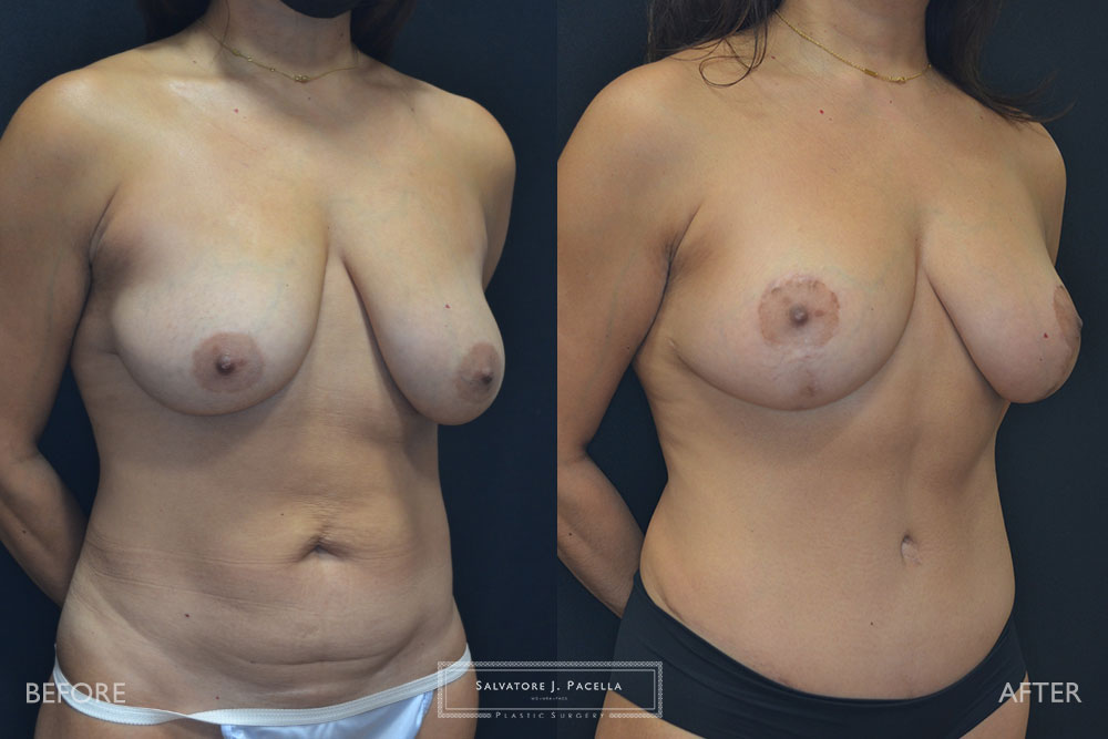 San Diego | La Jolla | Carmel Valley | Del Mar | Encinitas | Plastic Surgery | Body Contouring | Tummy Tuck | Mommy Makeover | Boob Job | Breast Augmentation | Top Plastic Surgeon