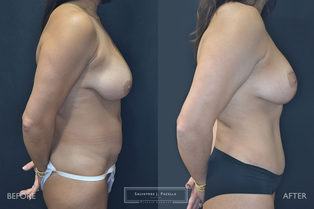 San Diego | La Jolla | Carmel Valley | Del Mar | Encinitas | Plastic Surgery | Body Contouring | Tummy Tuck | Mommy Makeover | Boob Job | Breast Augmentation | Top Plastic Surgeon