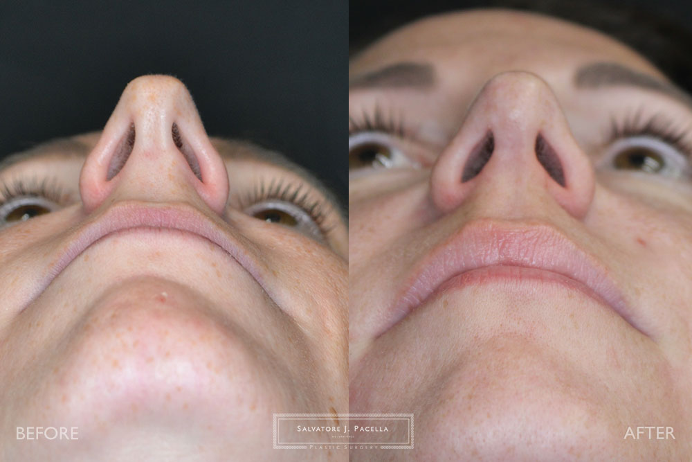 San Diego Rhinoplasty | La Jolla Rhinoplasty | Carmel Valley Rhinoplasty | Del Mar Rhinoplasty | San Diego Nose Job | La Jolla Nose Job | Carmel Valley Nose Job | Del Mar Nose Job | San Diego Chin Implant | La Jolla Chin Implant | Carmel Valley Chin Implant | Del Mar Chin Implant | San Diego Plastic Surgery | La Jolla Plastic Surgery | Carmel Valley Plastic Surgery | Del Mar Plastic Surgery | Scripps Plastic Surgeon