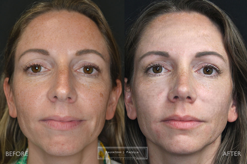 San Diego Rhinoplasty | La Jolla Rhinoplasty | Carmel Valley Rhinoplasty | Del Mar Rhinoplasty | San Diego Nose Job | La Jolla Nose Job | Carmel Valley Nose Job | Del Mar Nose Job | San Diego Chin Implant | La Jolla Chin Implant | Carmel Valley Chin Implant | Del Mar Chin Implant | San Diego Plastic Surgery | La Jolla Plastic Surgery | Carmel Valley Plastic Surgery | Del Mar Plastic Surgery | Scripps Plastic Surgeon