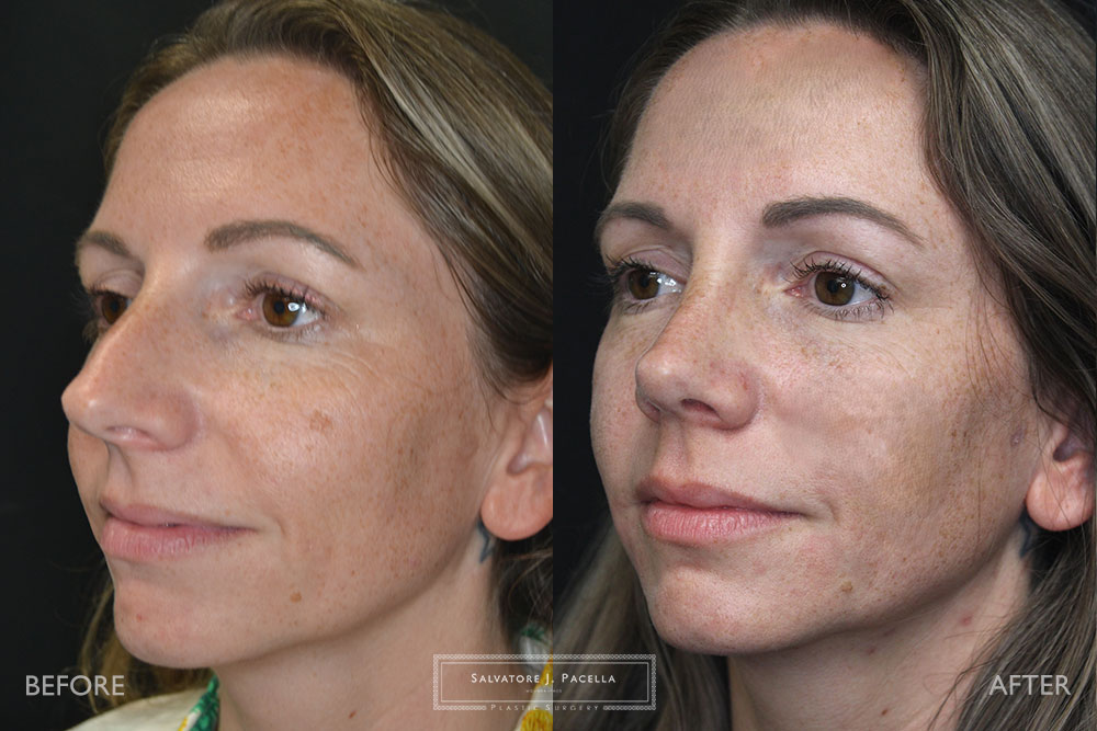 San Diego Rhinoplasty | La Jolla Rhinoplasty | Carmel Valley Rhinoplasty | Del Mar Rhinoplasty | San Diego Nose Job | La Jolla Nose Job | Carmel Valley Nose Job | Del Mar Nose Job | San Diego Chin Implant | La Jolla Chin Implant | Carmel Valley Chin Implant | Del Mar Chin Implant | San Diego Plastic Surgery | La Jolla Plastic Surgery | Carmel Valley Plastic Surgery | Del Mar Plastic Surgery | Scripps Plastic Surgeon