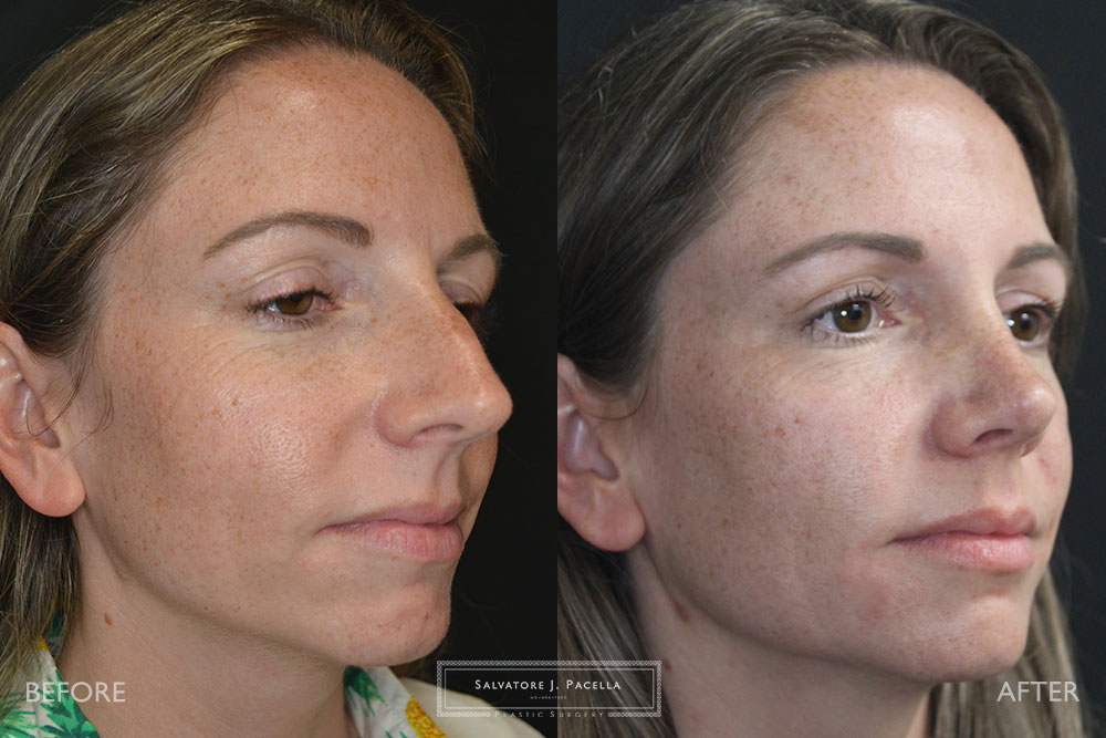 San Diego Rhinoplasty | La Jolla Rhinoplasty | Carmel Valley Rhinoplasty | Del Mar Rhinoplasty | San Diego Nose Job | La Jolla Nose Job | Carmel Valley Nose Job | Del Mar Nose Job | San Diego Chin Implant | La Jolla Chin Implant | Carmel Valley Chin Implant | Del Mar Chin Implant | San Diego Plastic Surgery | La Jolla Plastic Surgery | Carmel Valley Plastic Surgery | Del Mar Plastic Surgery | Scripps Plastic Surgeon