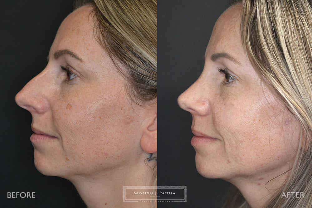 San Diego Rhinoplasty | La Jolla Rhinoplasty | Carmel Valley Rhinoplasty | Del Mar Rhinoplasty | San Diego Nose Job | La Jolla Nose Job | Carmel Valley Nose Job | Del Mar Nose Job | San Diego Chin Implant | La Jolla Chin Implant | Carmel Valley Chin Implant | Del Mar Chin Implant | San Diego Plastic Surgery | La Jolla Plastic Surgery | Carmel Valley Plastic Surgery | Del Mar Plastic Surgery | Scripps Plastic Surgeon