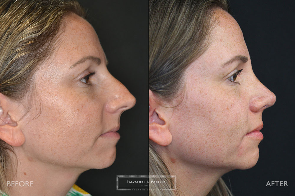 San Diego Rhinoplasty | La Jolla Rhinoplasty | Carmel Valley Rhinoplasty | Del Mar Rhinoplasty | San Diego Nose Job | La Jolla Nose Job | Carmel Valley Nose Job | Del Mar Nose Job | San Diego Chin Implant | La Jolla Chin Implant | Carmel Valley Chin Implant | Del Mar Chin Implant | San Diego Plastic Surgery | La Jolla Plastic Surgery | Carmel Valley Plastic Surgery | Del Mar Plastic Surgery | Scripps Plastic Surgeon