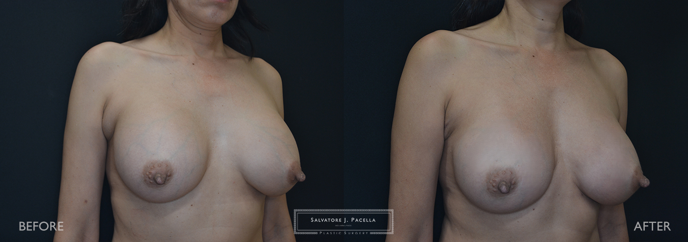 Scripps Plastic Surgeon | Plastic Surgery | Cosmetic Surgery | Breast Revision | Mastopexy | Mentor breast implants | San Diego | La Jolla | Breast Implants | Del Mar