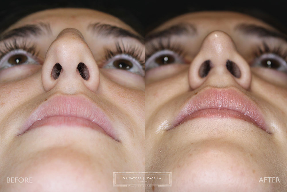 San Diego Rhinoplasty | La Jolla Rhinoplasty | Carmel Valley Rhinoplasty | Del Mar Rhinoplasty | San Diego Nose Job | La Jolla Nose Job | Carmel Valley Nose Job | Del Mar Nose Job | San Diego Chin Implant | La Jolla Chin Implant | Carmel Valley Chin Implant | Del Mar Chin Implant | San Diego Plastic Surgery | La Jolla Plastic Surgery | Carmel Valley Plastic Surgery | Del Mar Plastic Surgery | Scripps Plastic Surgeon