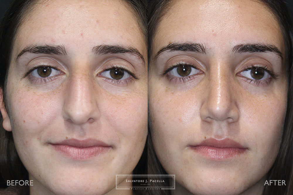 San Diego Rhinoplasty | La Jolla Rhinoplasty | Carmel Valley Rhinoplasty | Del Mar Rhinoplasty | San Diego Nose Job | La Jolla Nose Job | Carmel Valley Nose Job | Del Mar Nose Job | San Diego Chin Implant | La Jolla Chin Implant | Carmel Valley Chin Implant | Del Mar Chin Implant | San Diego Plastic Surgery | La Jolla Plastic Surgery | Carmel Valley Plastic Surgery | Del Mar Plastic Surgery | Scripps Plastic Surgeon