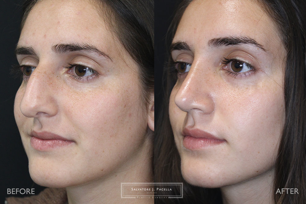 San Diego Rhinoplasty | La Jolla Rhinoplasty | Carmel Valley Rhinoplasty | Del Mar Rhinoplasty | San Diego Nose Job | La Jolla Nose Job | Carmel Valley Nose Job | Del Mar Nose Job | San Diego Chin Implant | La Jolla Chin Implant | Carmel Valley Chin Implant | Del Mar Chin Implant | San Diego Plastic Surgery | La Jolla Plastic Surgery | Carmel Valley Plastic Surgery | Del Mar Plastic Surgery | Scripps Plastic Surgeon