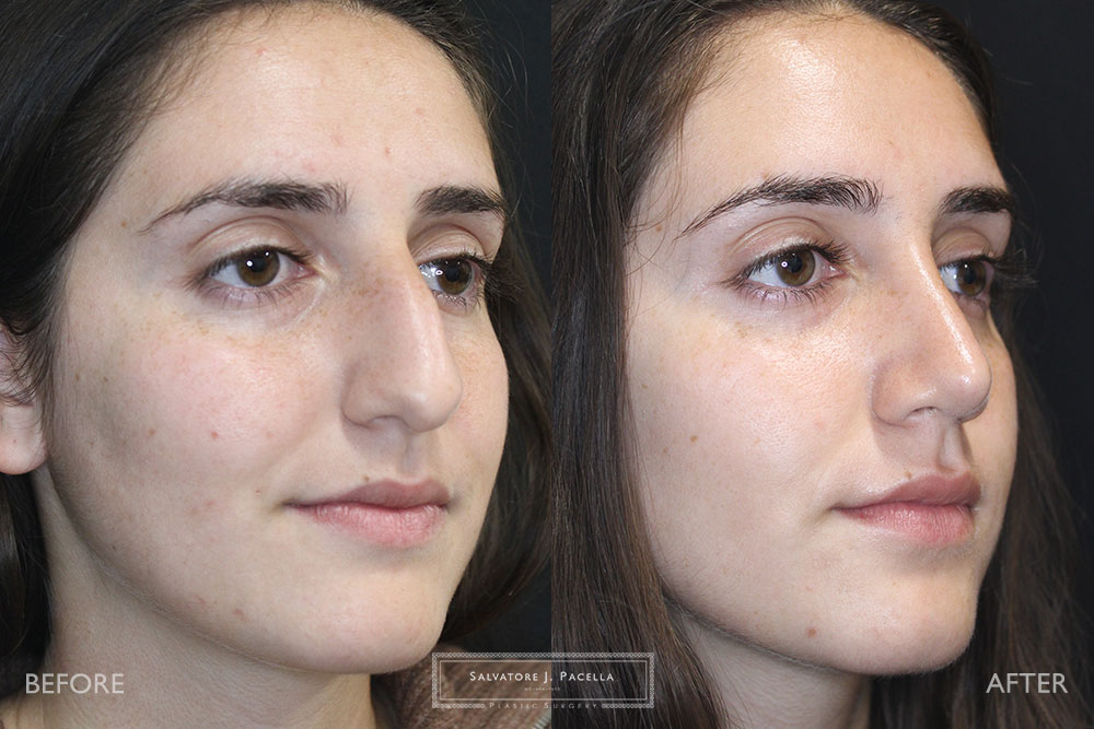 San Diego Rhinoplasty | La Jolla Rhinoplasty | Carmel Valley Rhinoplasty | Del Mar Rhinoplasty | San Diego Nose Job | La Jolla Nose Job | Carmel Valley Nose Job | Del Mar Nose Job | San Diego Chin Implant | La Jolla Chin Implant | Carmel Valley Chin Implant | Del Mar Chin Implant | San Diego Plastic Surgery | La Jolla Plastic Surgery | Carmel Valley Plastic Surgery | Del Mar Plastic Surgery | Scripps Plastic Surgeon