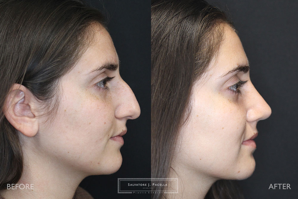 San Diego Rhinoplasty | La Jolla Rhinoplasty | Carmel Valley Rhinoplasty | Del Mar Rhinoplasty | San Diego Nose Job | La Jolla Nose Job | Carmel Valley Nose Job | Del Mar Nose Job | San Diego Chin Implant | La Jolla Chin Implant | Carmel Valley Chin Implant | Del Mar Chin Implant | San Diego Plastic Surgery | La Jolla Plastic Surgery | Carmel Valley Plastic Surgery | Del Mar Plastic Surgery | Scripps Plastic Surgeon