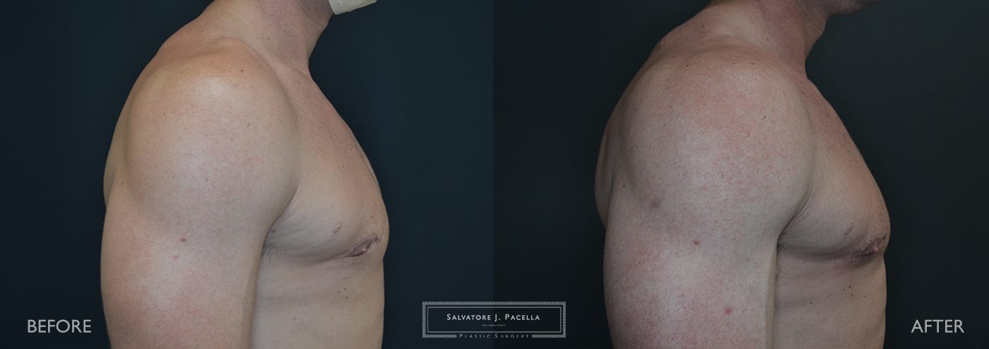 San Diego | La Jolla | Carmel Valley | Del Mar | Plastic Surgery | Gynecomastia | Male Breast Reduction | Top Plastic Surgeon | Scripps Plastic Surgeon