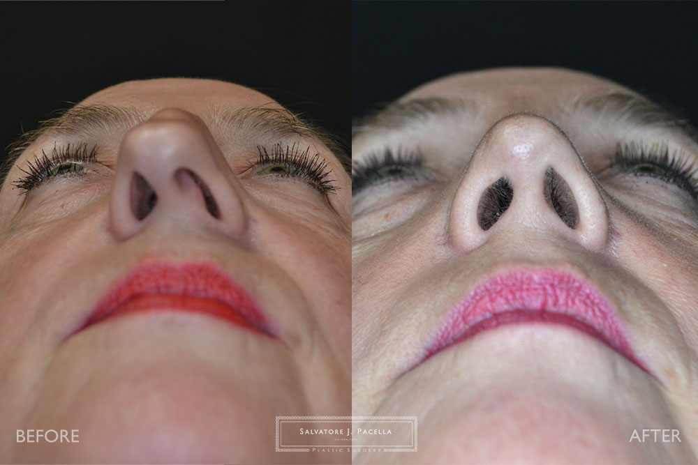 San Diego Rhinoplasty | La Jolla Rhinoplasty | Carmel Valley Rhinoplasty | Del Mar Rhinoplasty | San Diego Nose Job | La Jolla Nose Job | Carmel Valley Nose Job | Del Mar Nose Job | San Diego Chin Implant | La Jolla Chin Implant | Carmel Valley Chin Implant | Del Mar Chin Implant | San Diego Plastic Surgery | La Jolla Plastic Surgery | Carmel Valley Plastic Surgery | Del Mar Plastic Surgery | Scripps Plastic Surgeon