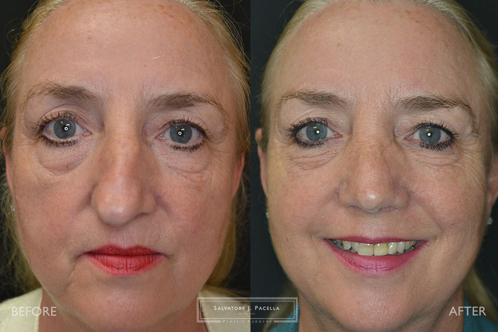 San Diego Rhinoplasty | La Jolla Rhinoplasty | Carmel Valley Rhinoplasty | Del Mar Rhinoplasty | San Diego Nose Job | La Jolla Nose Job | Carmel Valley Nose Job | Del Mar Nose Job | San Diego Chin Implant | La Jolla Chin Implant | Carmel Valley Chin Implant | Del Mar Chin Implant | San Diego Plastic Surgery | La Jolla Plastic Surgery | Carmel Valley Plastic Surgery | Del Mar Plastic Surgery | Scripps Plastic Surgeon