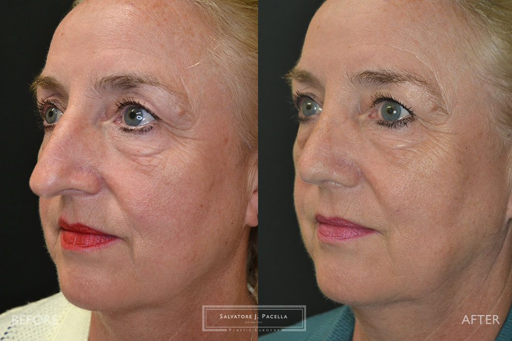 San Diego Rhinoplasty | La Jolla Rhinoplasty | Carmel Valley Rhinoplasty | Del Mar Rhinoplasty | San Diego Nose Job | La Jolla Nose Job | Carmel Valley Nose Job | Del Mar Nose Job | San Diego Chin Implant | La Jolla Chin Implant | Carmel Valley Chin Implant | Del Mar Chin Implant | San Diego Plastic Surgery | La Jolla Plastic Surgery | Carmel Valley Plastic Surgery | Del Mar Plastic Surgery | Scripps Plastic Surgeon