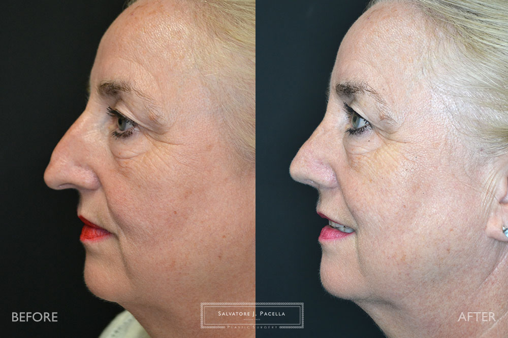 San Diego Rhinoplasty | La Jolla Rhinoplasty | Carmel Valley Rhinoplasty | Del Mar Rhinoplasty | San Diego Nose Job | La Jolla Nose Job | Carmel Valley Nose Job | Del Mar Nose Job | San Diego Chin Implant | La Jolla Chin Implant | Carmel Valley Chin Implant | Del Mar Chin Implant | San Diego Plastic Surgery | La Jolla Plastic Surgery | Carmel Valley Plastic Surgery | Del Mar Plastic Surgery | Scripps Plastic Surgeon