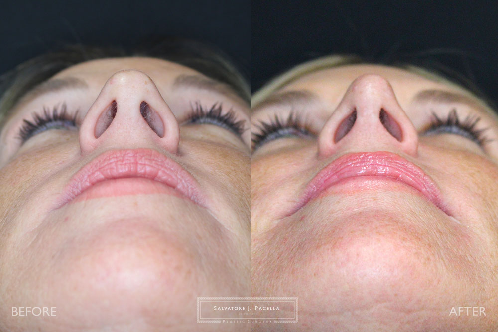 San Diego Rhinoplasty | La Jolla Rhinoplasty | Carmel Valley Rhinoplasty | Del Mar Rhinoplasty | San Diego Nose Job | La Jolla Nose Job | Carmel Valley Nose Job | Del Mar Nose Job | San Diego Chin Implant | La Jolla Chin Implant | Carmel Valley Chin Implant | Del Mar Chin Implant | San Diego Plastic Surgery | La Jolla Plastic Surgery | Carmel Valley Plastic Surgery | Del Mar Plastic Surgery | Scripps Plastic Surgeon