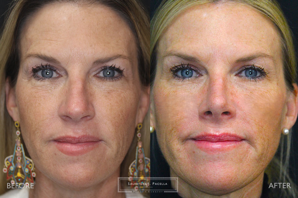 San Diego Rhinoplasty | La Jolla Rhinoplasty | Carmel Valley Rhinoplasty | Del Mar Rhinoplasty | San Diego Nose Job | La Jolla Nose Job | Carmel Valley Nose Job | Del Mar Nose Job | San Diego Chin Implant | La Jolla Chin Implant | Carmel Valley Chin Implant | Del Mar Chin Implant | San Diego Plastic Surgery | La Jolla Plastic Surgery | Carmel Valley Plastic Surgery | Del Mar Plastic Surgery | Scripps Plastic Surgeon