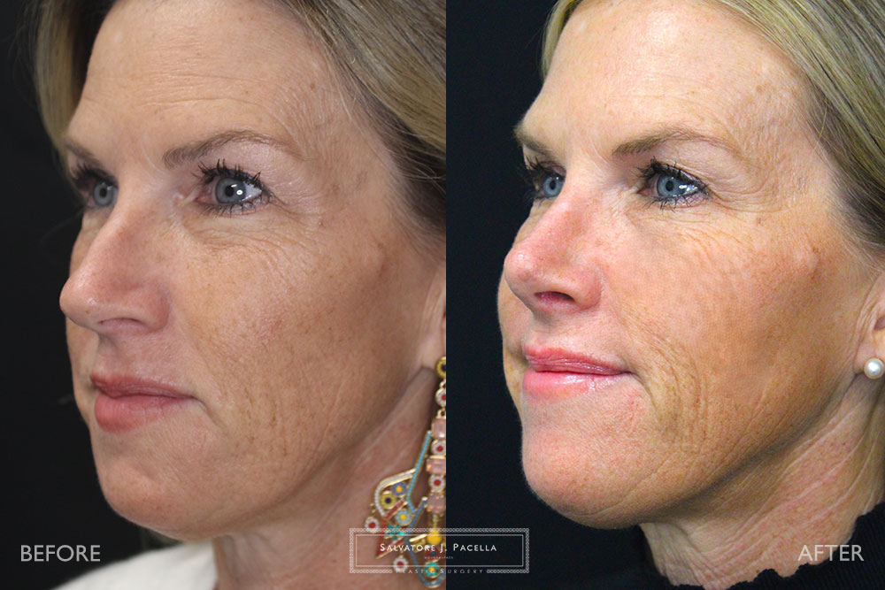 San Diego Rhinoplasty | La Jolla Rhinoplasty | Carmel Valley Rhinoplasty | Del Mar Rhinoplasty | San Diego Nose Job | La Jolla Nose Job | Carmel Valley Nose Job | Del Mar Nose Job | San Diego Chin Implant | La Jolla Chin Implant | Carmel Valley Chin Implant | Del Mar Chin Implant | San Diego Plastic Surgery | La Jolla Plastic Surgery | Carmel Valley Plastic Surgery | Del Mar Plastic Surgery | Scripps Plastic Surgeon