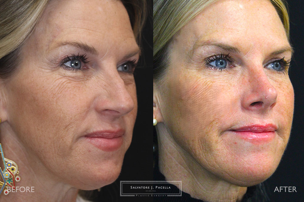 San Diego Rhinoplasty | La Jolla Rhinoplasty | Carmel Valley Rhinoplasty | Del Mar Rhinoplasty | San Diego Nose Job | La Jolla Nose Job | Carmel Valley Nose Job | Del Mar Nose Job | San Diego Chin Implant | La Jolla Chin Implant | Carmel Valley Chin Implant | Del Mar Chin Implant | San Diego Plastic Surgery | La Jolla Plastic Surgery | Carmel Valley Plastic Surgery | Del Mar Plastic Surgery | Scripps Plastic Surgeon