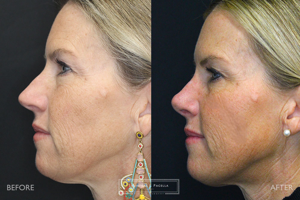 San Diego Rhinoplasty | La Jolla Rhinoplasty | Carmel Valley Rhinoplasty | Del Mar Rhinoplasty | San Diego Nose Job | La Jolla Nose Job | Carmel Valley Nose Job | Del Mar Nose Job | San Diego Chin Implant | La Jolla Chin Implant | Carmel Valley Chin Implant | Del Mar Chin Implant | San Diego Plastic Surgery | La Jolla Plastic Surgery | Carmel Valley Plastic Surgery | Del Mar Plastic Surgery | Scripps Plastic Surgeon