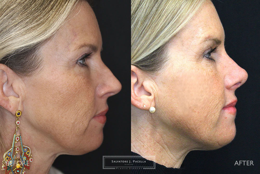 San Diego Rhinoplasty | La Jolla Rhinoplasty | Carmel Valley Rhinoplasty | Del Mar Rhinoplasty | San Diego Nose Job | La Jolla Nose Job | Carmel Valley Nose Job | Del Mar Nose Job | San Diego Chin Implant | La Jolla Chin Implant | Carmel Valley Chin Implant | Del Mar Chin Implant | San Diego Plastic Surgery | La Jolla Plastic Surgery | Carmel Valley Plastic Surgery | Del Mar Plastic Surgery | Scripps Plastic Surgeon
